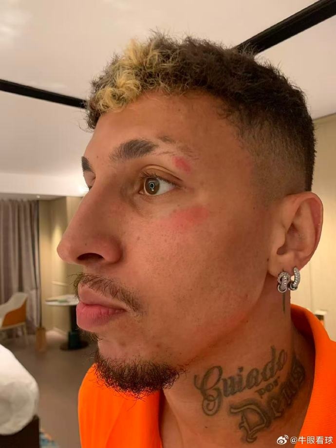 記者：克雷桑頭部被踢了一下，換下他是用了腦震蕩條款